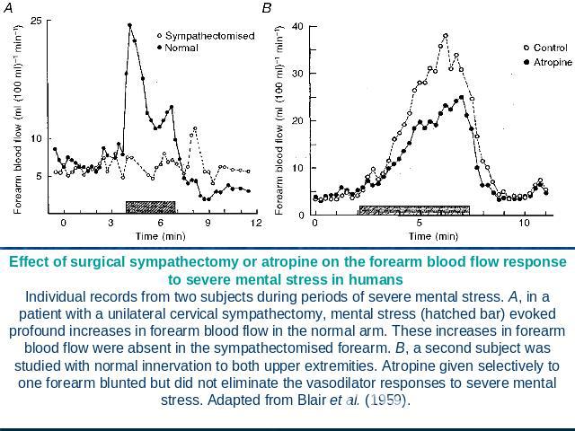 Effect of surgical sympathectomy or atropine on the forearm blood flow response to severe mental stress in humans Individual records from two subjects during periods of severe mental stress. A, in a patient with a unilateral cervical sympathectomy, …