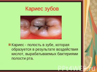 Кариес зубов Кариес - полость в зубе, которая образуется в результате воздействи