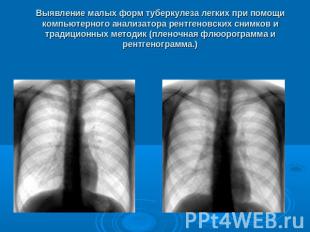 Выявление малых форм туберкулеза легких при помощи компьютерного анализатора рен