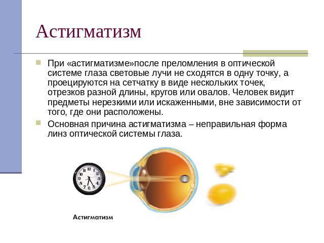 Астигматизм При «астигматизме»после преломления в оптической системе глаза световые лучи не сходятся в одну точку, а проецируются на сетчатку в виде нескольких точек, отрезков разной длины, кругов или овалов. Человек видит предметы нерезкими или иск…