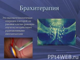 Брахитерапия Это высокотехнологичная операция в которой на раковые клетки (раков