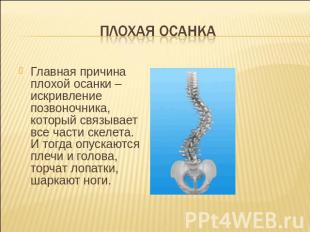 Плохая осанка Главная причина плохой осанки – искривление позвоночника, который