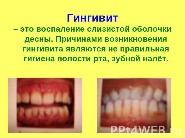 Гингивит– это воспаление слизистой оболочки десны. Причинами возникновения гингивита являются не правильная гигиена полости рта, зубной налёт.