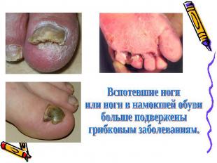 Вспотевшие ноги или ноги в намокшей обувибольше подверженыгрибковым заболеваниям