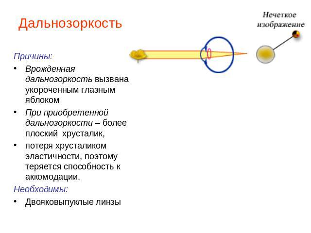 Дальнозоркость Причины:Врожденная дальнозоркость вызвана укороченным глазным яблокомПри приобретенной дальнозоркости – более плоский хрусталик, потеря хрусталиком эластичности, поэтому теряется способность к аккомодации. Необходимы:Двояковыпуклые линзы