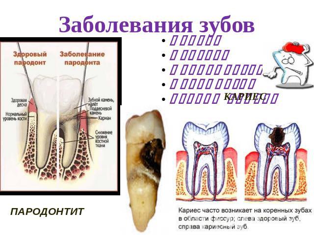 Заболевания зубовКариесПульпитПериодонтитПародонтитЗубной камень