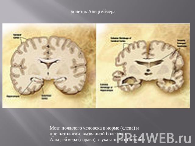 Болезнь Альцгеймера Мозг пожилого человека в норме (слева) и при патологии, вызванной болезнью Альцгеймера (справа), с указанием отличий.