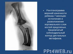 Рентгенограмма верхней конечности ребенка 7 месяцев: истончение и разволокнение