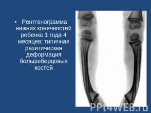 Рентгенограмма нижних конечностей ребенка 1 года 4 месяцев: типичная рахитическа