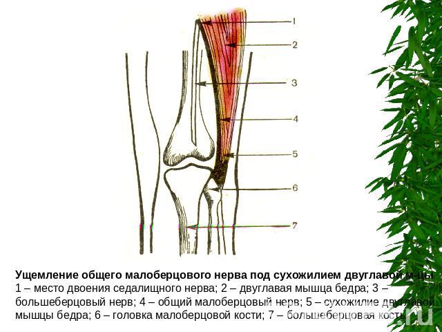 Ущемление общего малоберцового нерва под сухожилием двуглавой м-цы1 – место двоения седалищного нерва; 2 – двуглавая мышца бедра; 3 – большеберцовый нерв; 4 – общий малоберцовый нерв; 5 – сухожилие двуглавой мышцы бедра; 6 – головка малоберцовой кос…