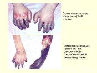 Отморожение пальцев обеих кистей II–III степени Отморожение пальцев правой кисти