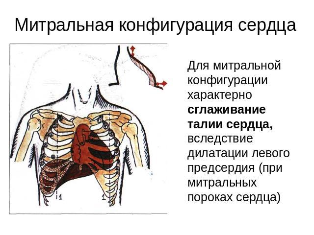 Митральная конфигурация сердца Для митральной конфигурации характерно сглаживание талии сердца, вследствие дилатации левого предсердия (при митральных пороках сердца)