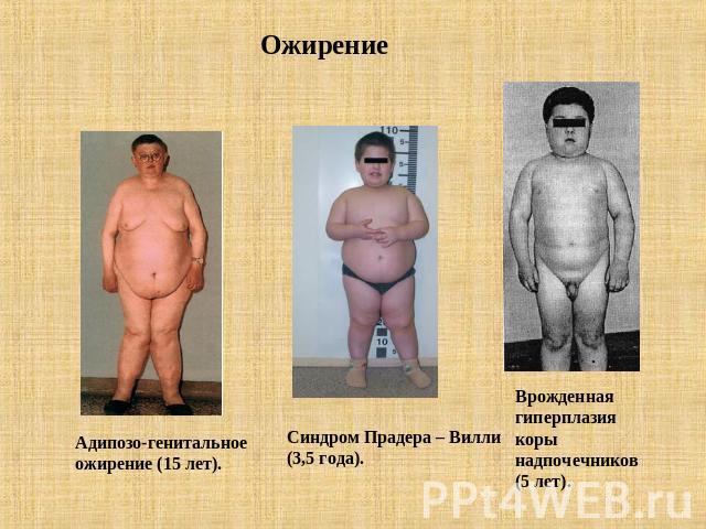 Ожирение Адипозо-генитальноеожирение (15 лет). Синдром Прадера – Вилли(3,5 года). Врожденнаягиперплазиякоры надпочечников(5 лет).