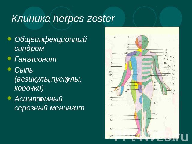 Клиника herpes zoster Общеинфекционный синдромГанглионитСыпь (везикулы,пустулы, корочки)Асимптомный серозный менингит