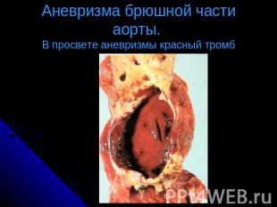 Аневризма брюшной части аорты. В просвете аневризмы красный тромб