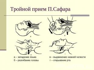 Тройной прием П.Сафара а – западение языка в – выдвижение нижней челюстиб – разг