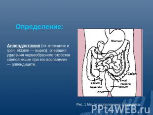 Определение: Аппендэктомия (от аппендикс и греч. ektome — вырез), операция удале