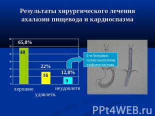 Результаты хирургического лечения ахалазии пищевода и кардиоспазма 2-м больнымпо