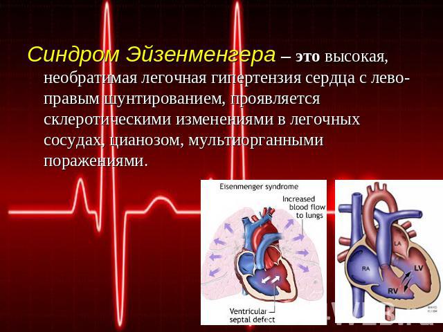 Синдром Эйзенменгера – это высокая, необратимая легочная гипертензия сердца с лево-правым шунтированием, проявляется склеротическими изменениями в легочных сосудах, цианозом, мультиорганными поражениями.