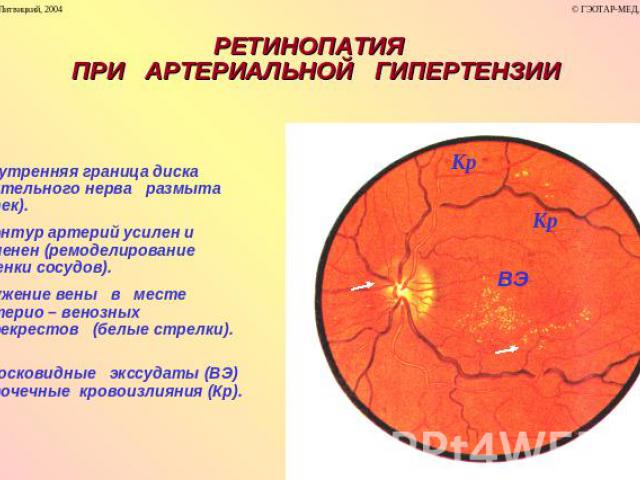 РЕТИНОПАТИЯ ПРИ АРТЕРИАЛЬНОЙ ГИПЕРТЕНЗИИ Внутренняя граница диска зрительного нерва размыта (отек). Контур артерий усилен и изменен (ремоделирование стенки сосудов). Сужение вены в месте артерио – венозных перекрестов (белые стрелки). Восковидные эк…