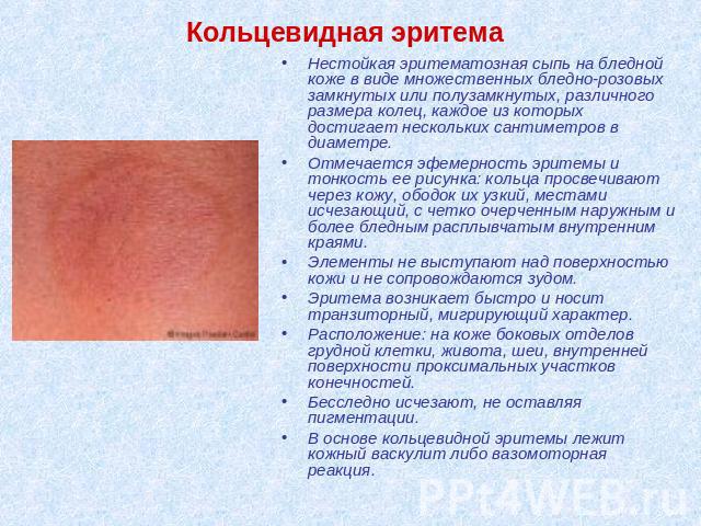 Кольцевидная эритема Нестойкая эритематозная сыпь на бледной коже в виде множественных бледно-розовых замкнутых или полузамкнутых, различного размера колец, каждое из которых достигает нескольких сантиметров в диаметре. Отмечается эфемерность эритем…