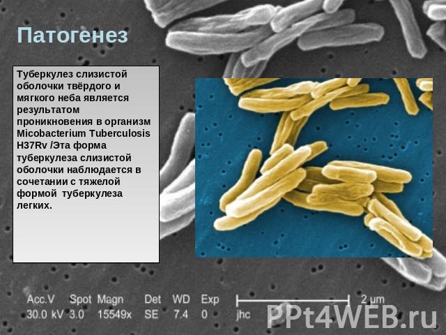 Патогенез Туберкулез слизистой оболочки твёрдого и мягкого неба является результатом проникновения в организм Micobacterium Tuberculosis H37Rv /Эта форма туберкулеза слизистой оболочки наблюдается в сочетании с тяжелой формой туберкулеза легких.