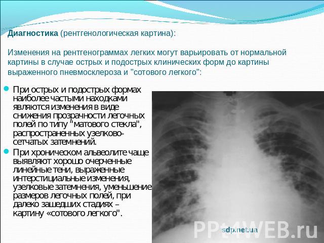 Диагностика (рентгенологическая картина): Изменения на рентгенограммах легких могут варьировать от нормальной картины в случае острых и подострых клинических форм до картины выраженного пневмосклероза и 