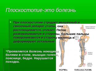 Плоскостопие-это болезнь При плоскостопии страдает мышечный и связочный аппарат