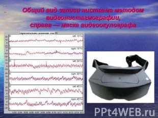 Общий вид записи нистагма методом видеонистагмографии,справа — маска видеоокулог