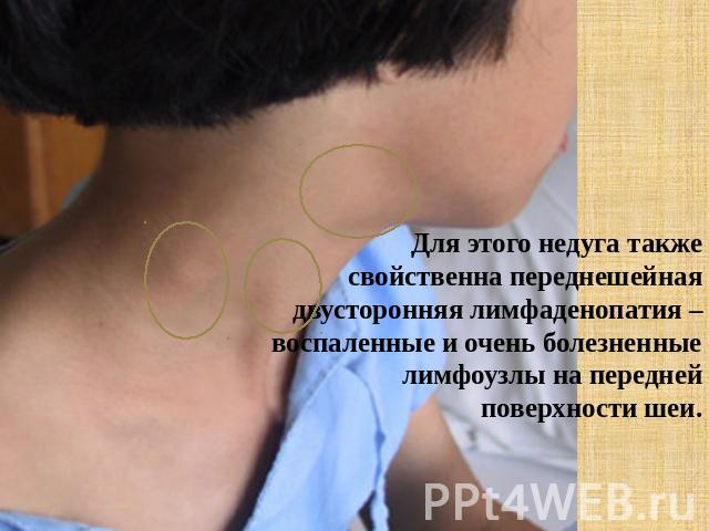 Для этого недуга также свойственна переднешейная двусторонняя лимфаденопатия – воспаленные и очень болезненные лимфоузлы на передней поверхности шеи.