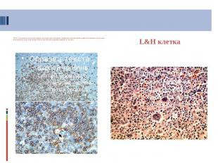 CD20 – позитивные клетки нодулярной структуры при нодулярном лимфоидном преоблад