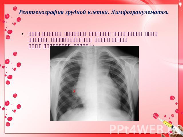 Рентгенография грудной клетки. Лимфогранулематоз. Расширение верхних отделов срединной тени вправо, обусловленное поражением лимфатических узлов. 