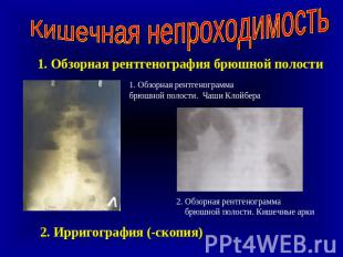 Кишечная непроходимость 1. Обзорная рентгенография брюшной полости 1. Обзорная р