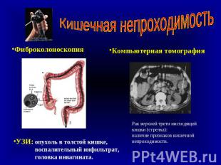 Кишечная непроходимость Фиброколоноскопия УЗИ: опухоль в толстой кишке, воспалит
