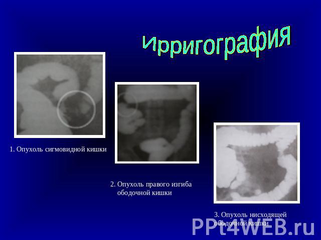 Ирригография1. Опухоль сигмовидной кишки 2. Опухоль правого изгиба ободочной кишки3. Опухоль нисходящей ободочной кишки