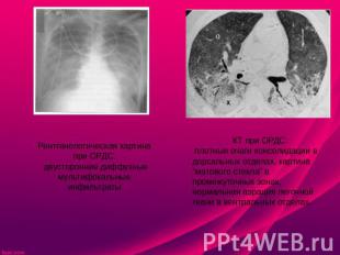 Рентгенологическая картина при ОРДС: двусторонние диффузные мультифокальные инфи