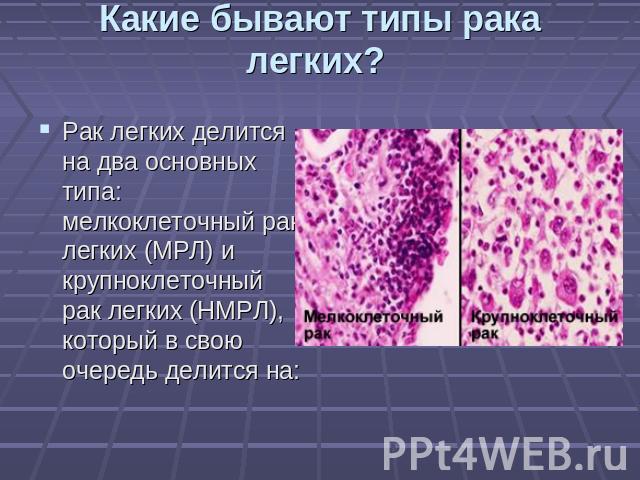 Какие бывают типы рака легких? Рак легких делится на два основных типа: мелкоклеточный рак легких (МРЛ) и крупноклеточный рак легких (НМРЛ), который в свою очередь делится на: