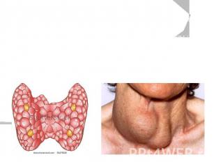 Причины гипотиреоза :-повреждение паренхимы щитовидной железы со стороны собстве