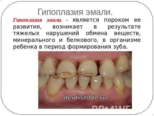 Гипоплазия эмали. Гипоплазия эмали - является пороком ее развития, возникает в результате тяжелых нарушений обмена веществ, минерального и белкового, в организме ребенка в период формирования зуба.