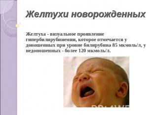 Желтухи новорожденных Желтуха - визуальное проявление гипербилирубинемии, которо