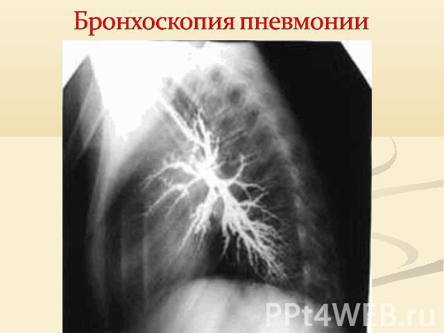 Бронхоскопия пневмонии