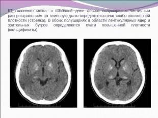 КТ головного мозга: в височной доле левого полушария с частичным распространение