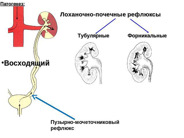 Лоханочно-почечные рефлюксы Тубулярные ФорникальныеВосходящий Пузырно-мочеточниковый рефлюкс