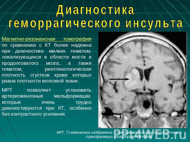 Диагностика геморрагического инсульта Магнитно-резонансная томография по сравнению с КТ более надежна при диагностике мелких гематом, локализующихся в области моста и продолговатого мозга, а также гематом, рентгенологическая плотность сгустков крови…