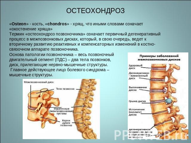 ОСТЕОХОНДРОЗ «Osteon» - кость, «chondros» - хрящ, что иными словами означает «окостенение хряща»Термин «остеохондроз позвоночника» означает первичный дегенеративный процесс в межпозвонковых дисках, который, в свою очередь, ведет к вторичному развити…
