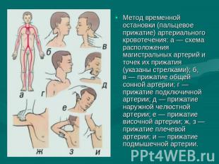 Метод временной остановки (пальцевое прижатие) артериального кровотечения: а — с