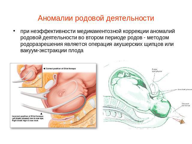 Аномалии родовой деятельности при неэффективности медикаментозной коррекции аномалий родовой деятельности во втором периоде родов - методом родоразрешения является операция акушерских щипцов или вакуум-экстракции плода