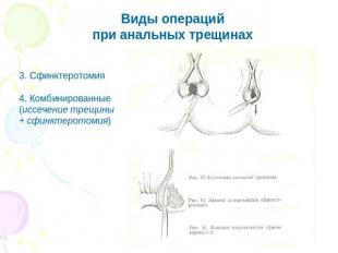Виды операцийпри анальных трещинах 3. Сфинктеротомия4. Комбинированные (иссечени