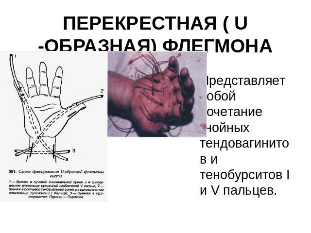 ПЕРЕКРЕСТНАЯ ( U -ОБРАЗНАЯ) ФЛЕГМОНА КИСТИ Представляет собой сочетание гнойных тендовагинитов и тенобурситов I и V пальцев.