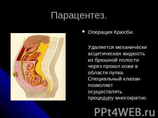 Парацентез. Операция Крюсби. Удаляется механически асцитическая жидкость из брюш